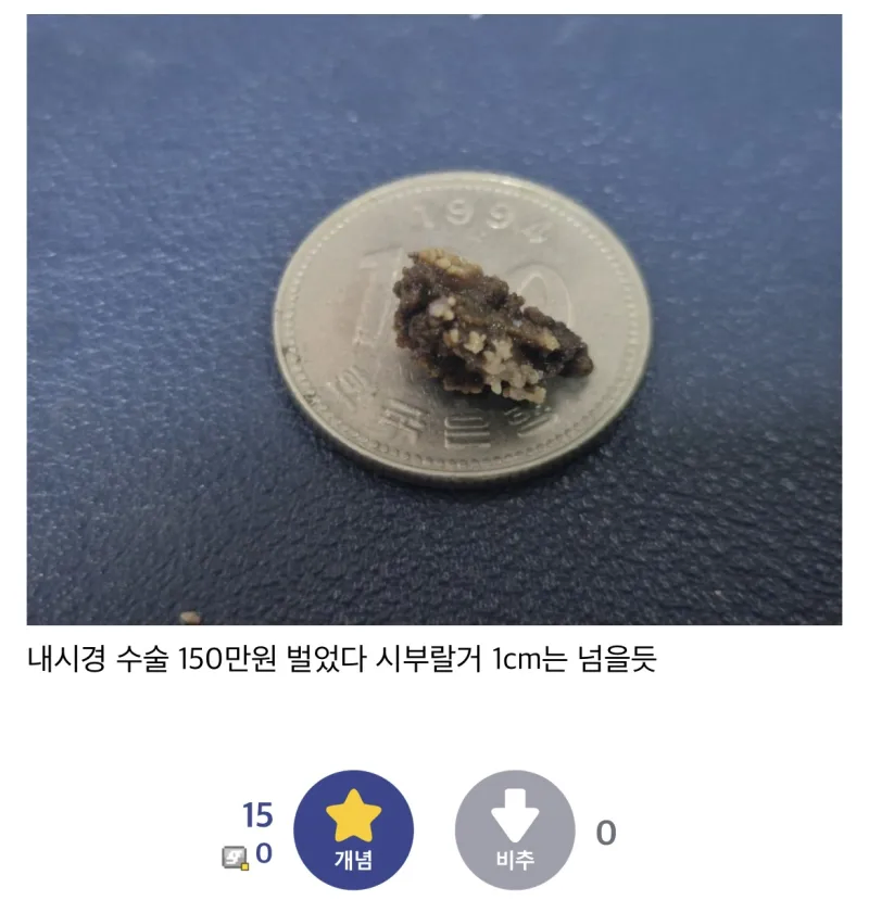 역대급 크기의 결석을 자연배출한 디시인_2.webp