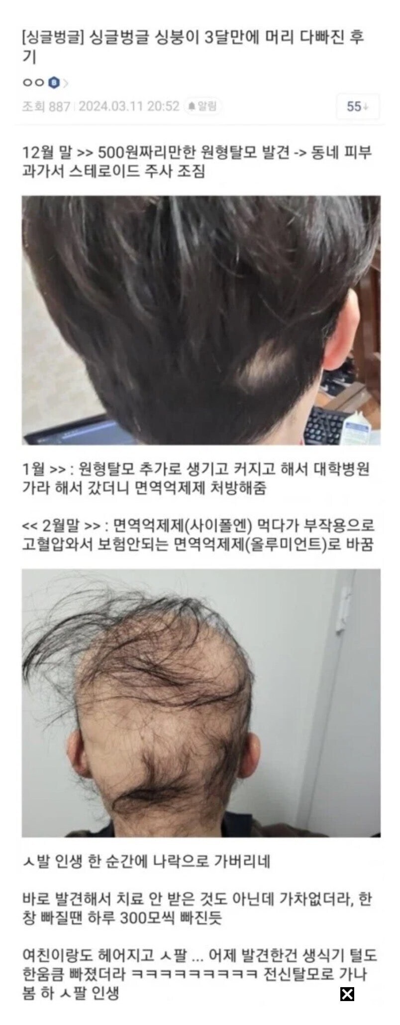 디시 탈모 레전드 (혐주의)_1.jpg