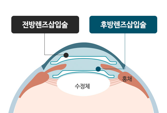 버튜버)페코라가 햇다는 ICL이 뭐냐_2.jpg