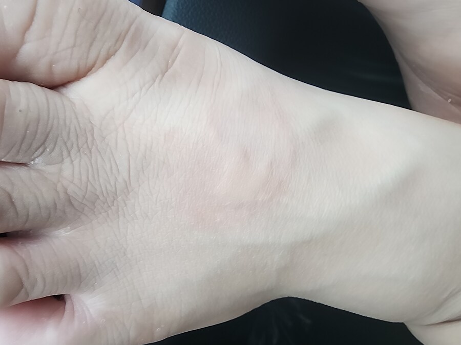 아 모기물림 ㅡㅡ_1.jpg