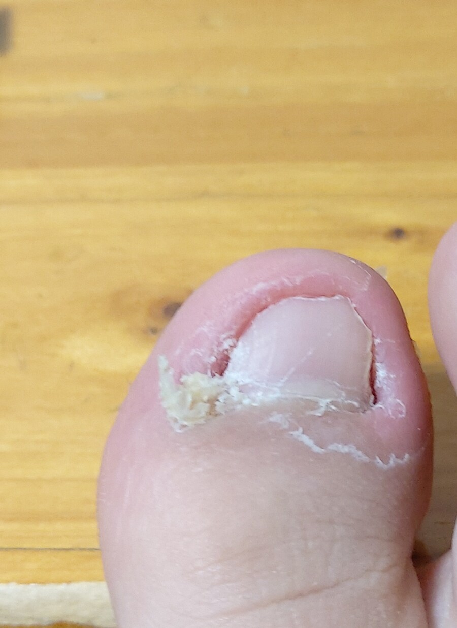 혐) 새벽을 일깨우는 내성발톱, 통풍, 사마귀_5.jpg