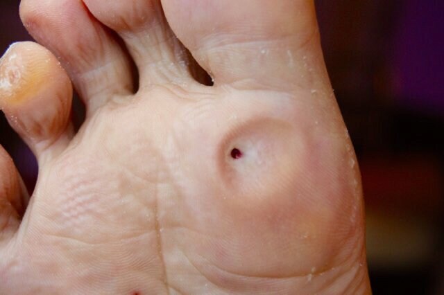 혐) 새벽을 일깨우는 내성발톱, 통풍, 사마귀_9.jpg