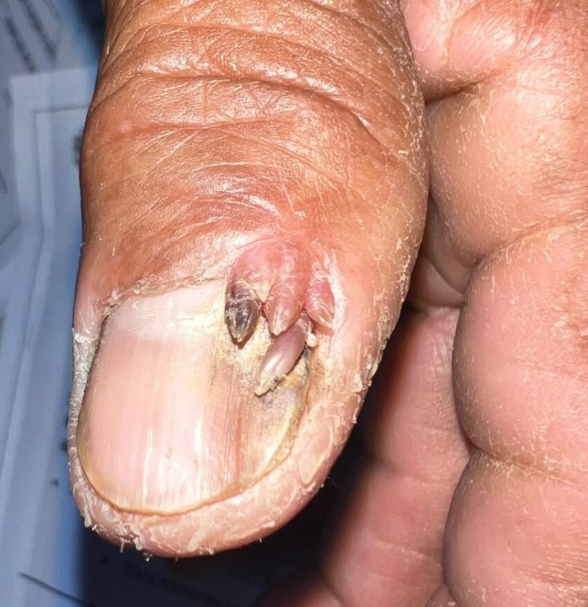 혐) 새벽을 일깨우는 내성발톱, 통풍, 사마귀_13.jpg