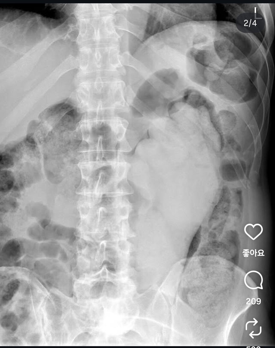 혐) 항문에 이물이 들어간 사람들의 변명_3.jpg