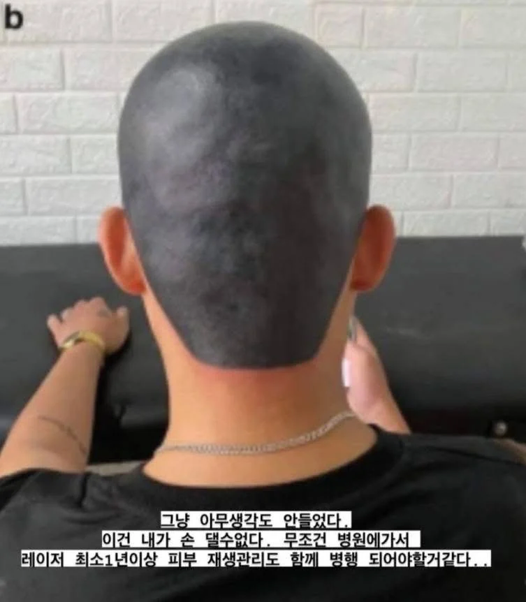 다른데서 망해온 문신 손도 못대고 병원에 보낸 문신사_3.webp