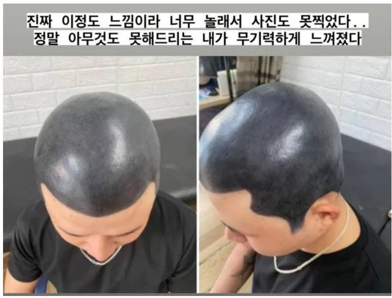 다른데서 망해온 문신 손도 못대고 병원에 보낸 문신사_2.webp