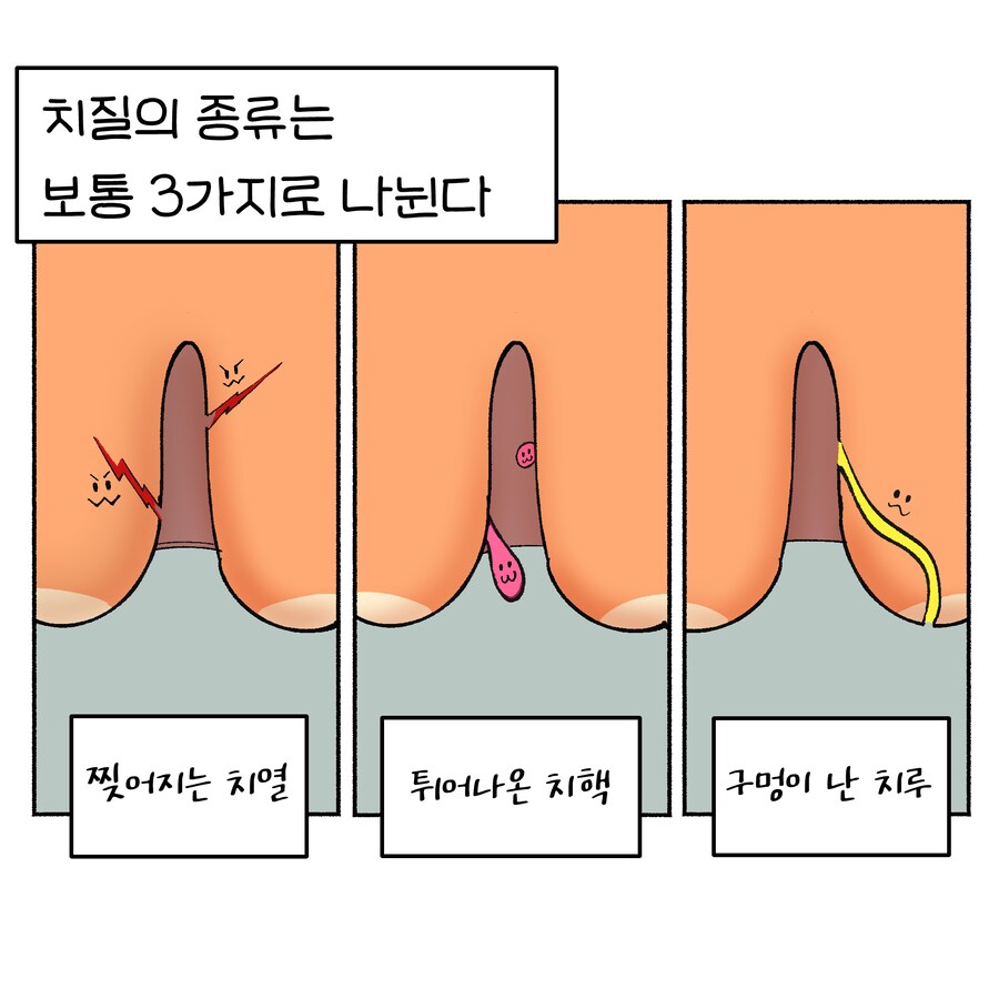 위기의 치질수술 1~3_12.png