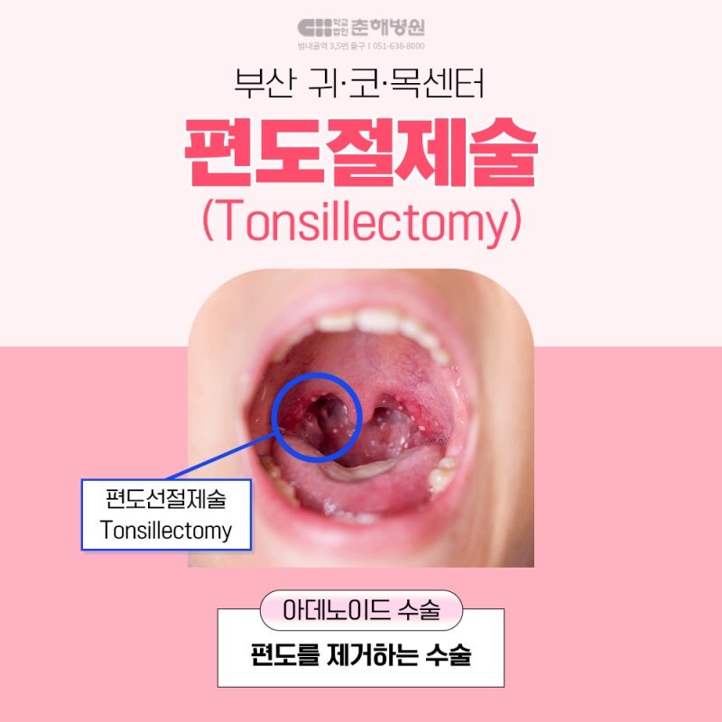 은근히 단점보다 장점이 많은 수술_2.jpg