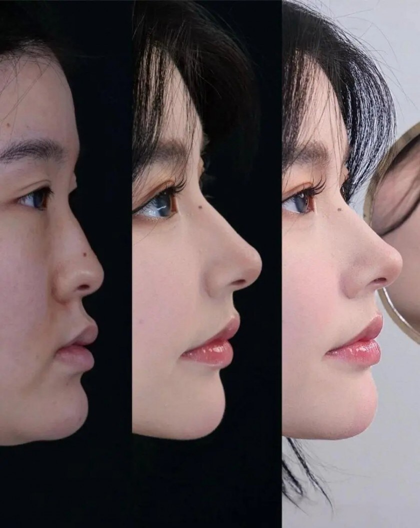 최신 성형 기술 근황_1.jpg