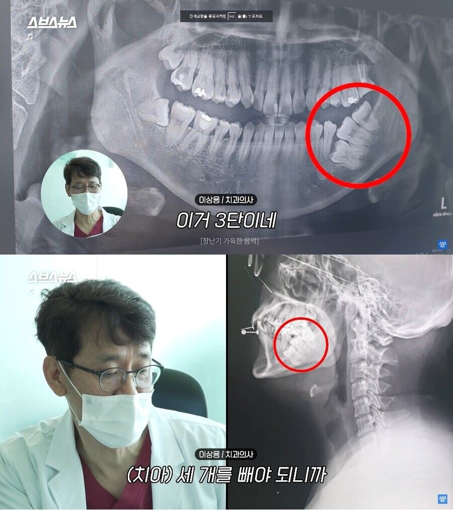 약혐)전설의 3단 사랑니_1.jpg