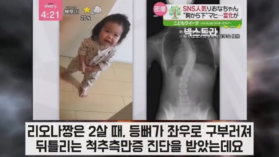 한글 공부하는 일본 난치병 어린이 신기록 근황_2.jpg