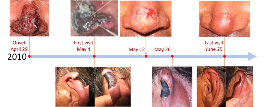 약혐) 플라시보라는 걸로는 설명이 안되는 침술 사례_3.png