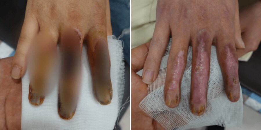 약혐) 플라시보라는 걸로는 설명이 안되는 침술 사례_6.png