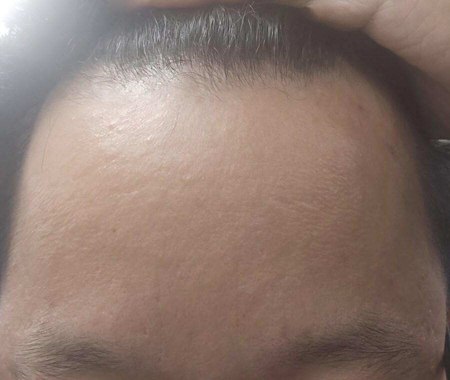 타코야키(진) 약 복용 1년 하고 4개월 경과_2.jpg