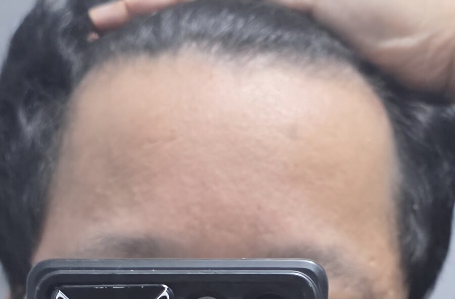 타코야키(진) 약 복용 1년 하고 4개월 경과_4.jpg