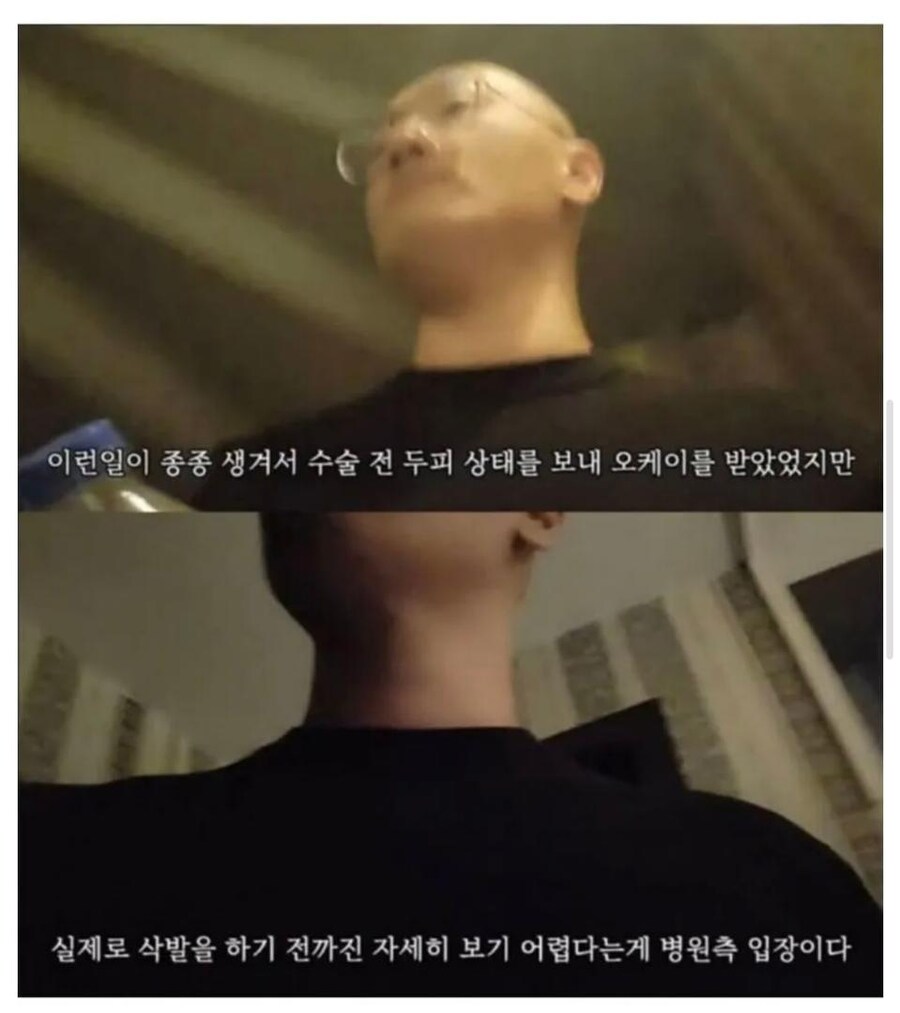 터키로 모발이식 받으러간 남성_2.jpg
