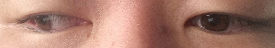 눈 사시가 심한데 알바 면접이요_1.webp