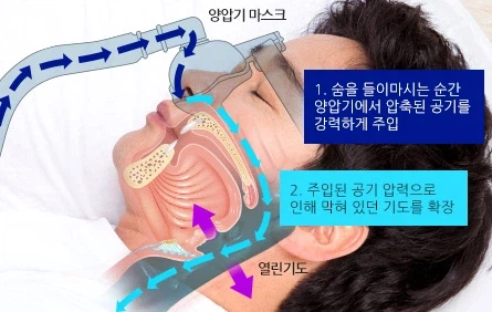 효과도 검증되고 사용자도 만족한다고 하지만 선뜻 추천하기 어려운 기기_2.webp