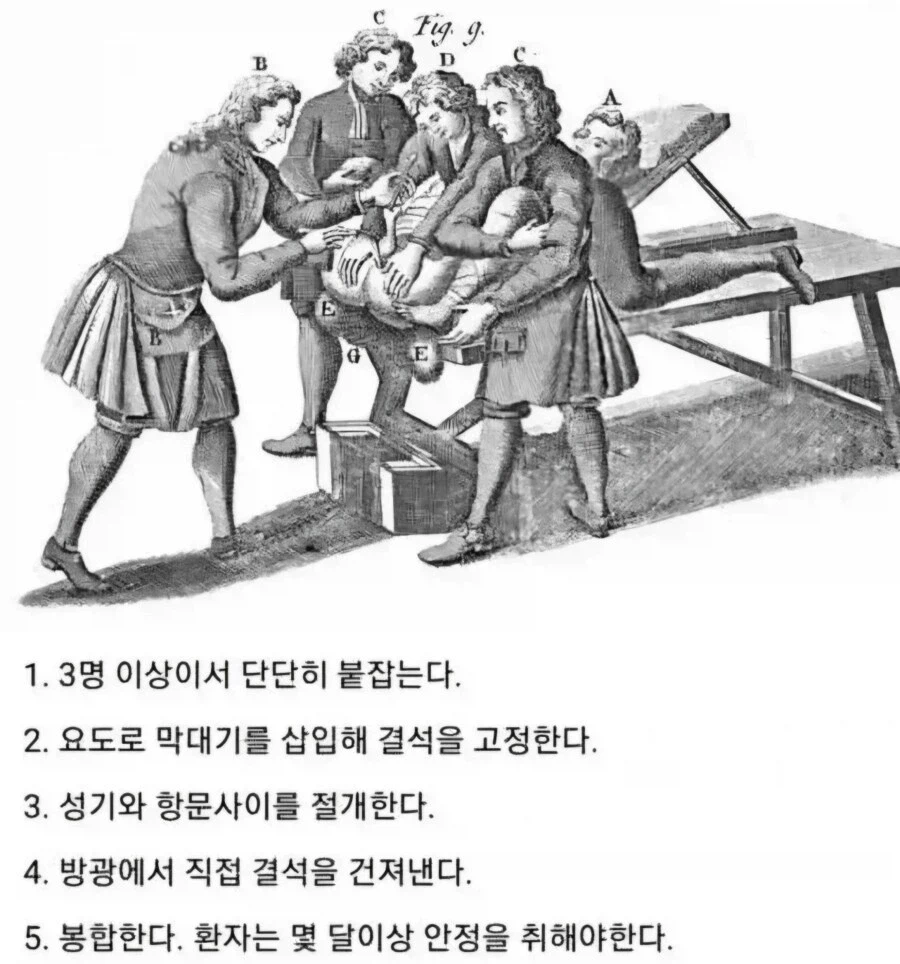 중세시대 요로결석 수술.jpg_1.webp