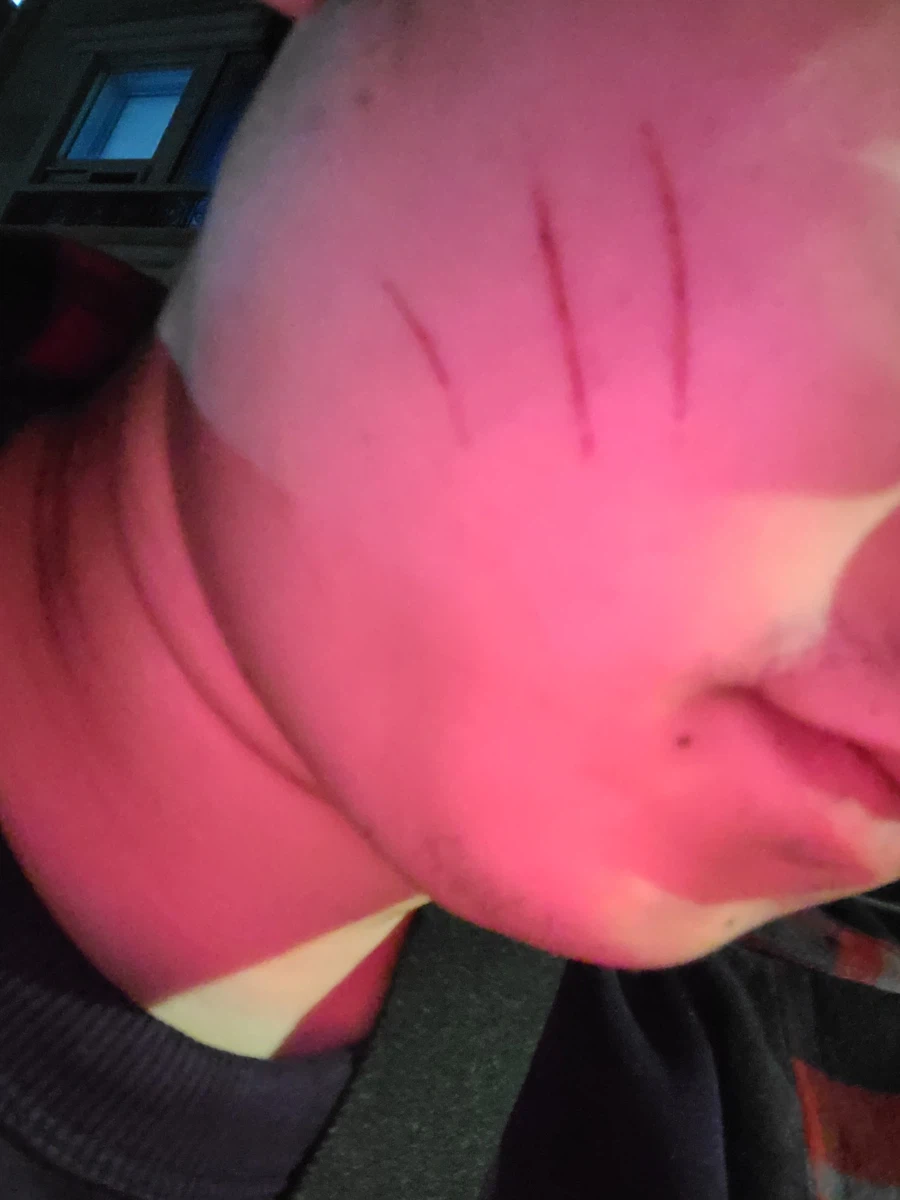 이틀 전에 자다가 긁은건지는 모르겠는데_1.webp