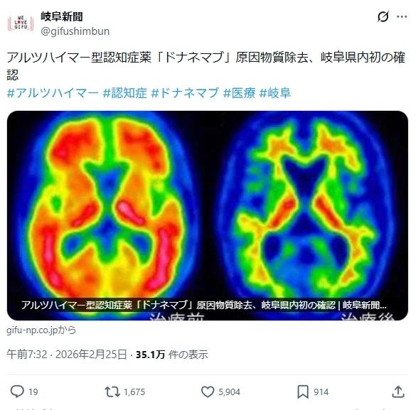 현재 가장 가능성있는 알츠하이머 치료제 근황_1.webp