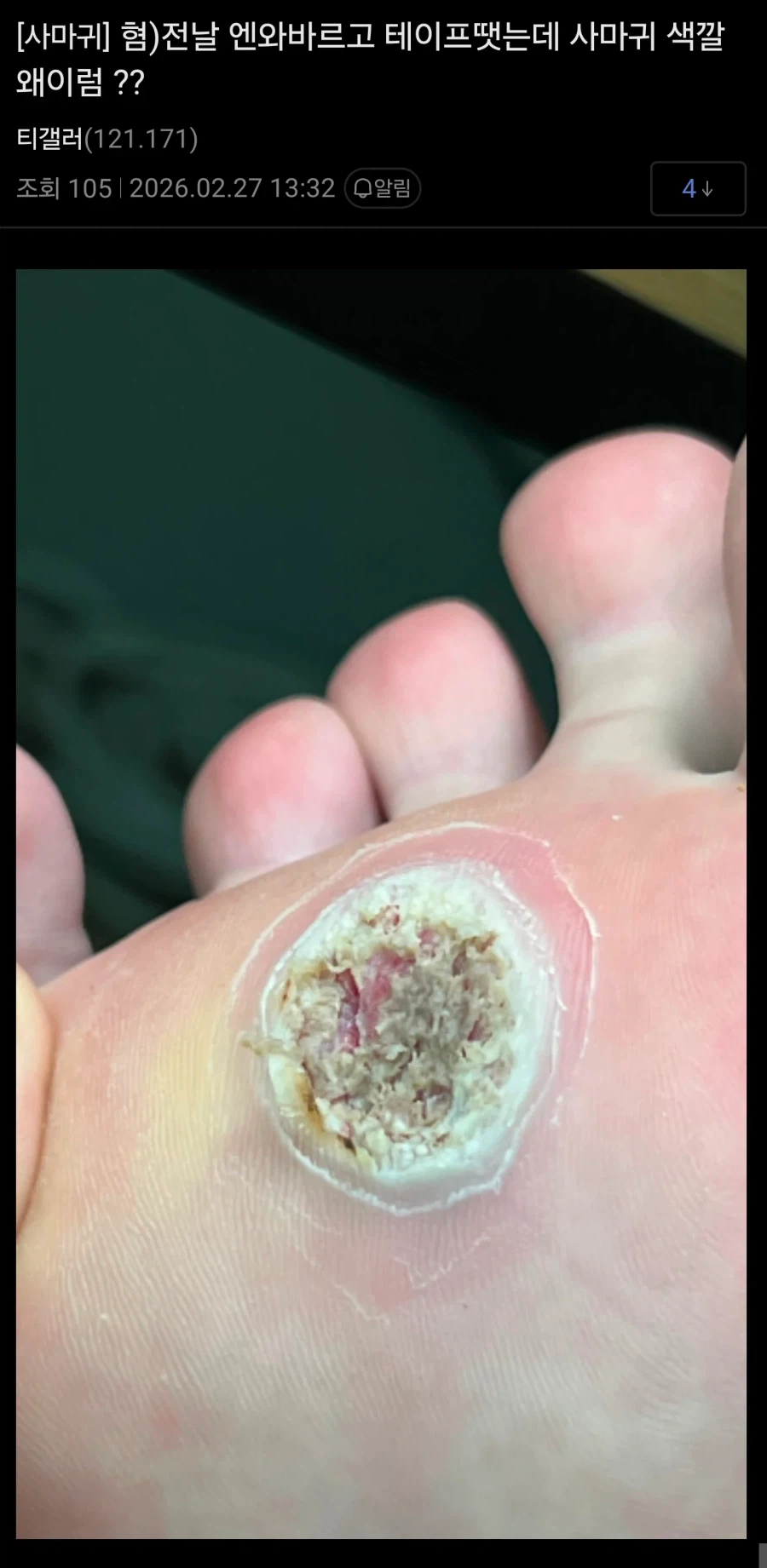 (혐) 티눈갤 근황_1.webp