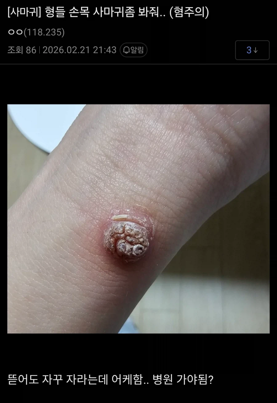 (혐) 티눈갤 근황_5.webp