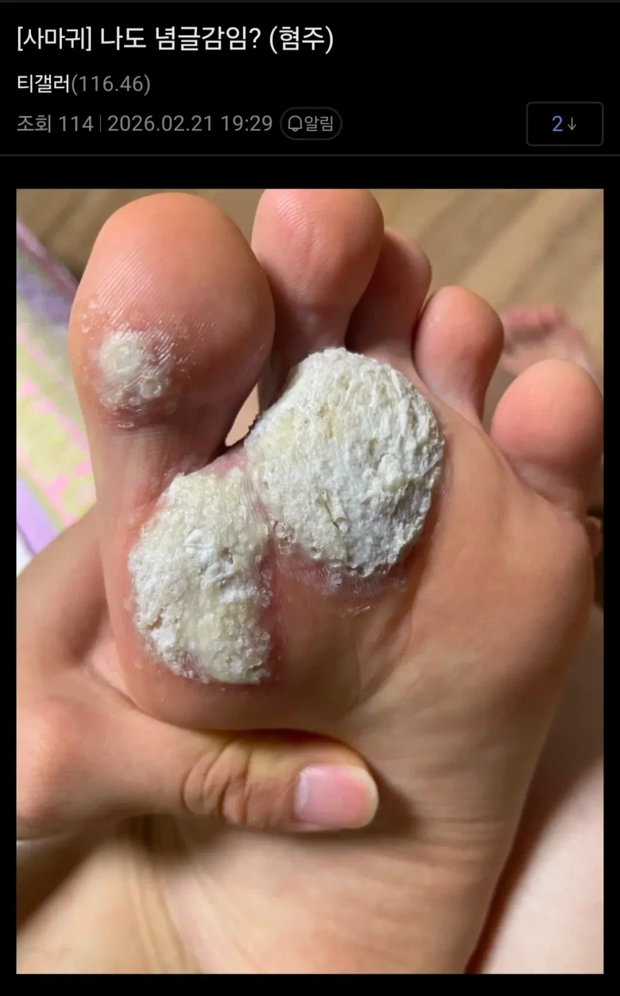 혐) 티눈갤 근황_5.webp