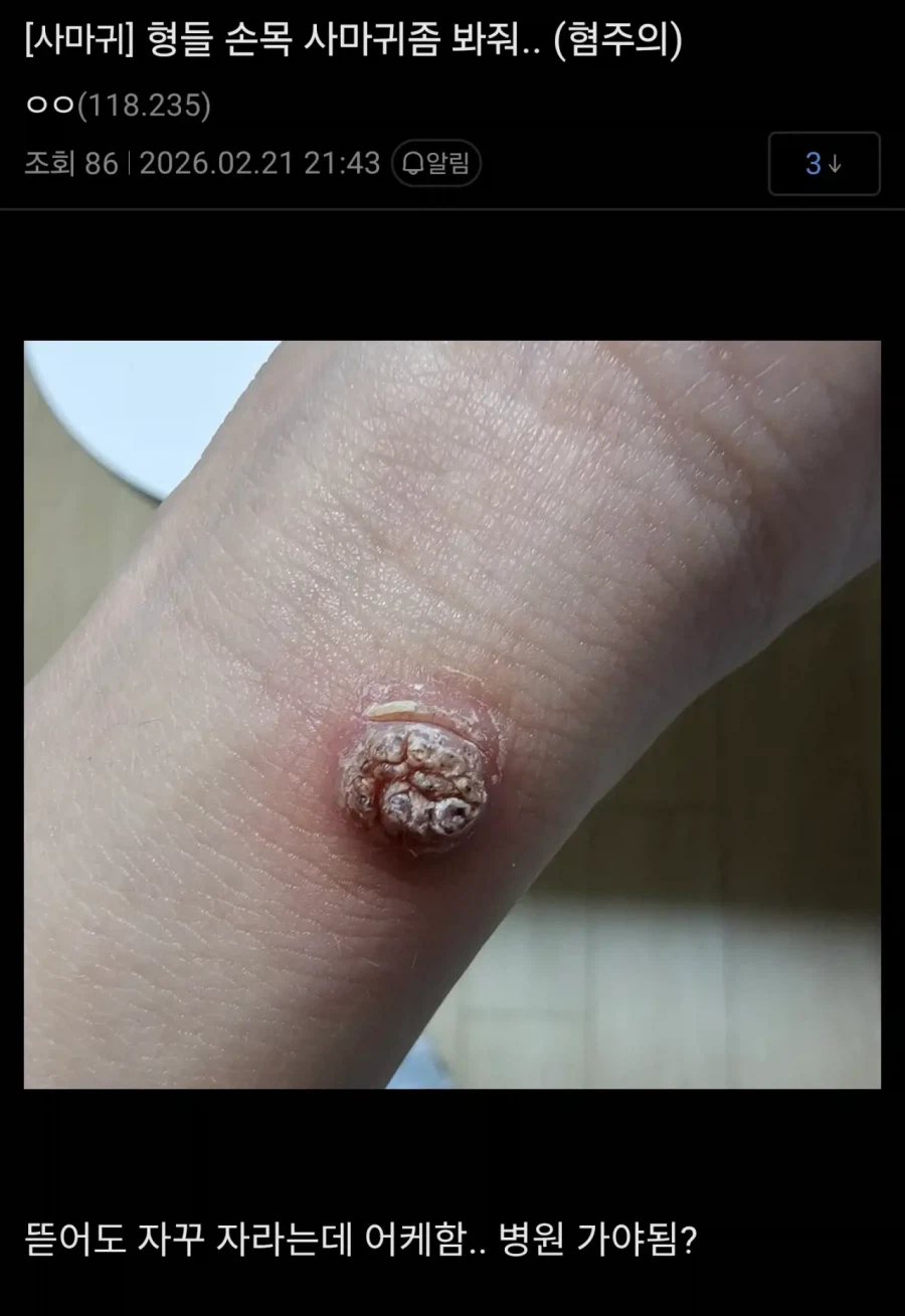 혐) 티눈갤 근황_6.webp