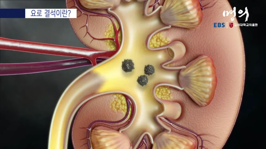 요로 결석이란?_3.webp