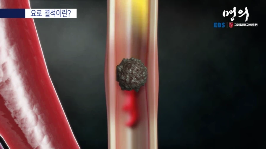 요로 결석이란?_6.webp