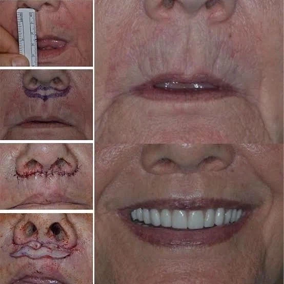 어려보이게 하는 성형수술 원리.jpg_1.webp